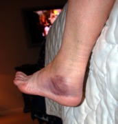 2009-02-08-01 SPRAINED ANKLE.jpg